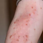 virus Mpox